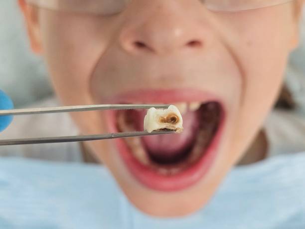 Best Chipped Tooth Repair Near Me  in Tucumcari, NM